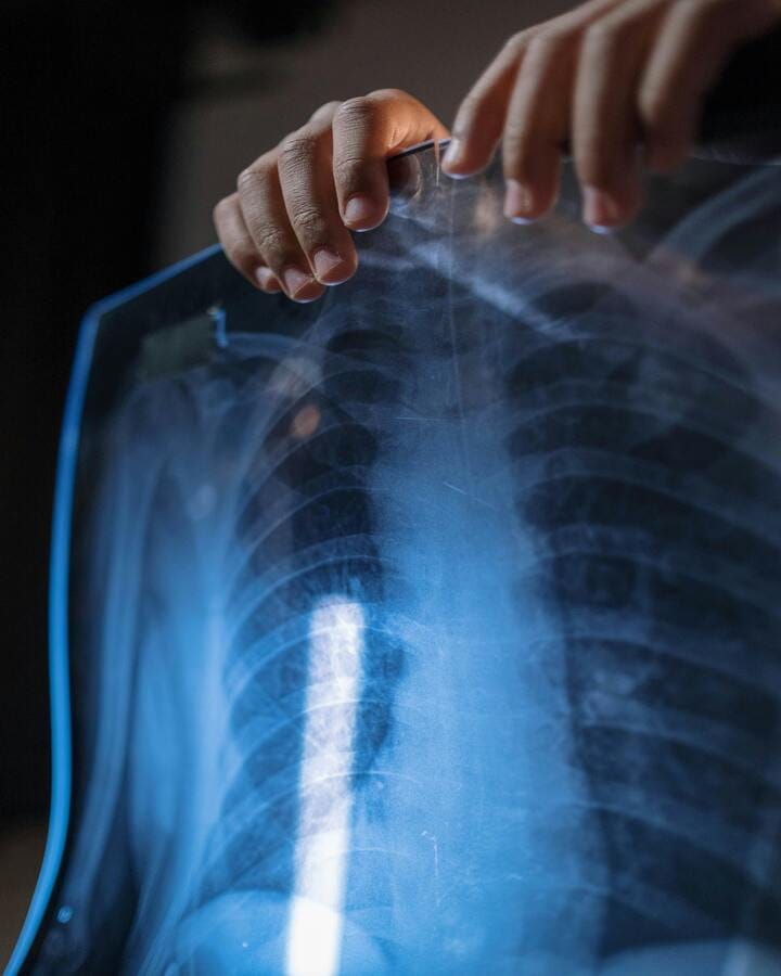 Cystic Fibrosis Lung Infection Treatment